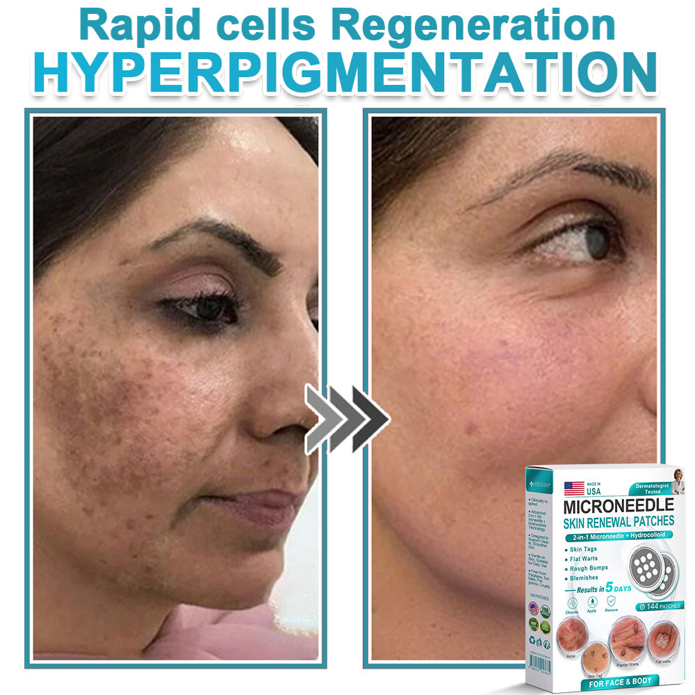 HERB & VITAL Official Store -  2-in-1 Microneedle & Hydrocolloid Patch👨‍⚕️ | Removes raised moles, acne, flat warts, and skin tags | Helps improve wrinkles, scars, and blemishes | Invisible patches for face and body