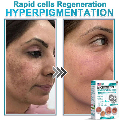 HERB & VITAL Official Store -  2-in-1 Microneedle & Hydrocolloid Patch👨‍⚕️ | Removes raised moles, acne, flat warts, and skin tags | Helps improve wrinkles, scars, and blemishes | Invisible patches for face and body