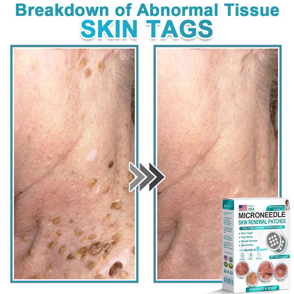 HERB & VITAL Official Store -  2-in-1 Microneedle & Hydrocolloid Patch👨‍⚕️ | Removes raised moles, acne, flat warts, and skin tags | Helps improve wrinkles, scars, and blemishes | Invisible patches for face and body