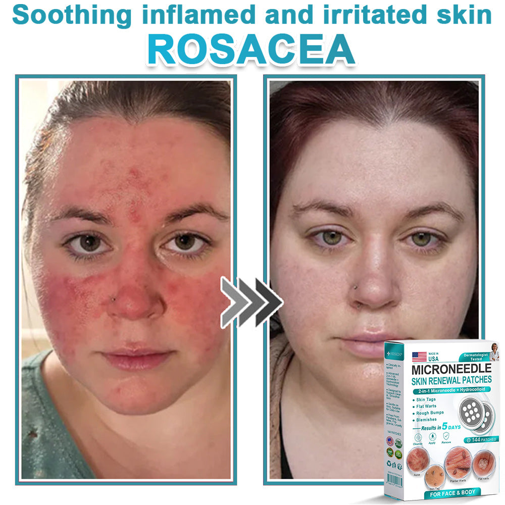 HERB & VITAL Official Store -  2-in-1 Microneedle & Hydrocolloid Patch👨‍⚕️ | Removes raised moles, acne, flat warts, and skin tags | Helps improve wrinkles, scars, and blemishes | Invisible patches for face and body