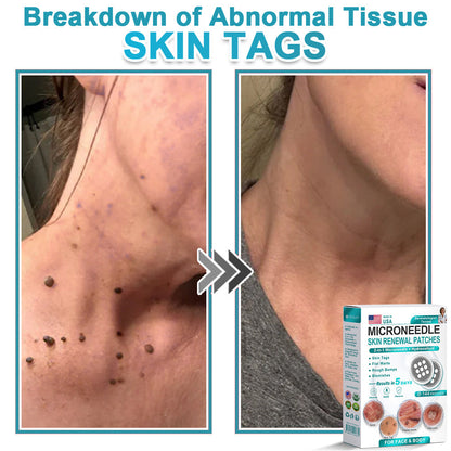 HERB & VITAL Official Store -  2-in-1 Microneedle & Hydrocolloid Patch👨‍⚕️ | Removes raised moles, acne, flat warts, and skin tags | Helps improve wrinkles, scars, and blemishes | Invisible patches for face and body