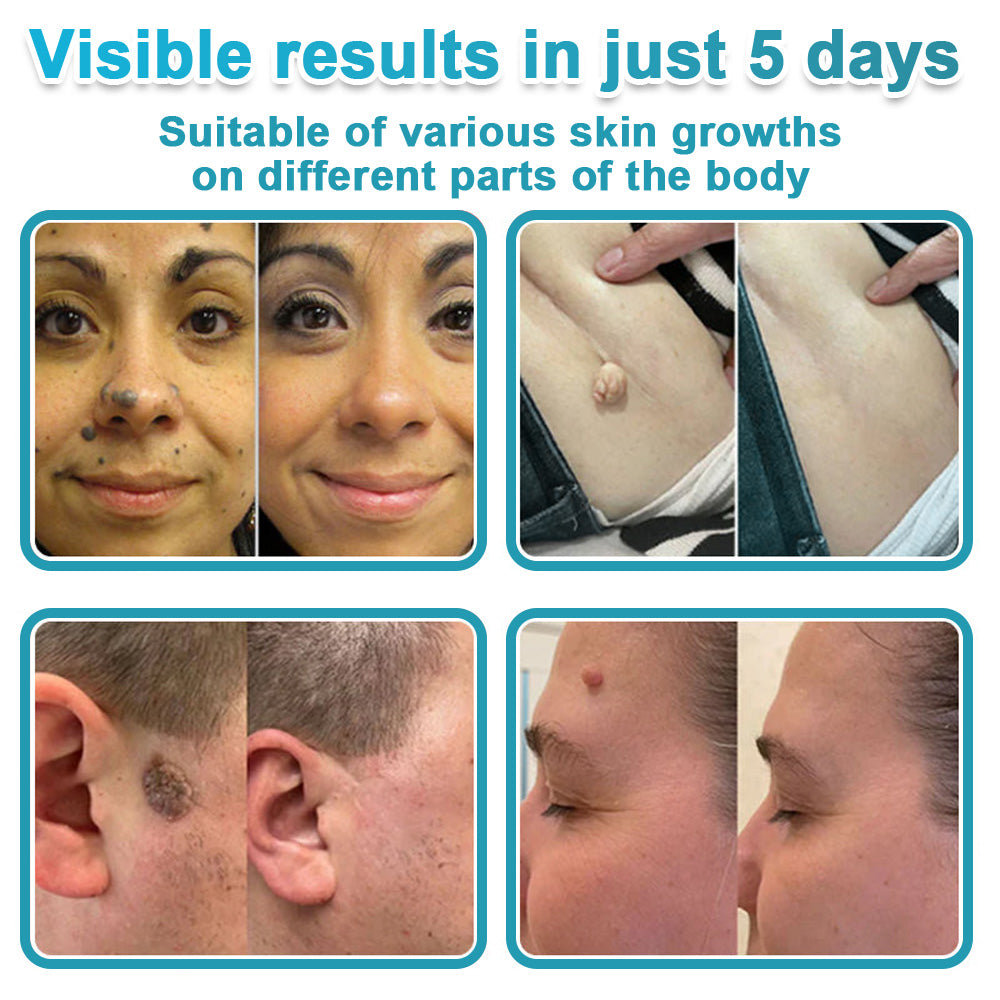 HERB & VITAL Official Store -  2-in-1 Microneedle & Hydrocolloid Patch👨‍⚕️ | Removes raised moles, acne, flat warts, and skin tags | Helps improve wrinkles, scars, and blemishes | Invisible patches for face and body
