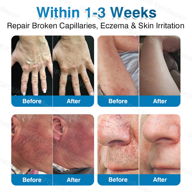 🇺🇸🏅🌱HERB & VITAL Official Store -  VeinRepair Microneedle Patch Roll⚡Instant Relief, Long-Term Results