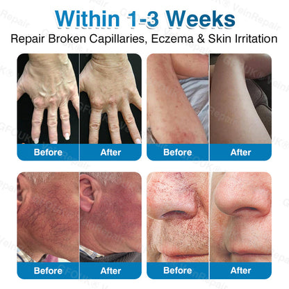 🇺🇸🏅🌱HERB & VITAL Official Store -  VeinRepair Microneedle Patch Roll⚡Instant Relief, Long-Term Results