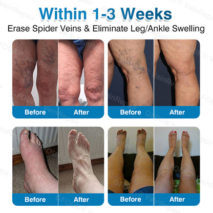 🇺🇸🏅🌱HERB & VITAL Official Store -  VeinRepair Microneedle Patch Roll⚡Instant Relief, Long-Term Results