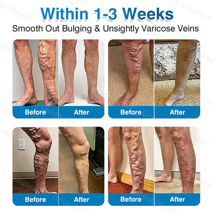 🇺🇸🏅🌱HERB & VITAL Official Store -  VeinRepair Microneedle Patch Roll⚡Instant Relief, Long-Term Results
