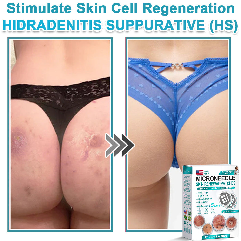 HERB & VITAL Official Store -  2-in-1 Microneedle & Hydrocolloid Patch👨‍⚕️ | Removes raised moles, acne, flat warts, and skin tags | Helps improve wrinkles, scars, and blemishes | Invisible patches for face and body