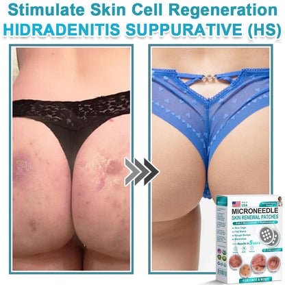 HERB & VITAL Official Store -  2-in-1 Microneedle & Hydrocolloid Patch👨‍⚕️ | Removes raised moles, acne, flat warts, and skin tags | Helps improve wrinkles, scars, and blemishes | Invisible patches for face and body