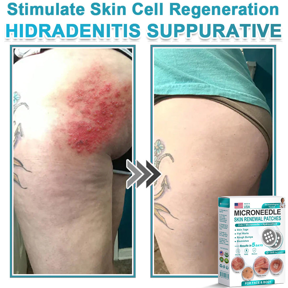 HERB & VITAL Official Store -  2-in-1 Microneedle & Hydrocolloid Patch👨‍⚕️ | Removes raised moles, acne, flat warts, and skin tags | Helps improve wrinkles, scars, and blemishes | Invisible patches for face and body