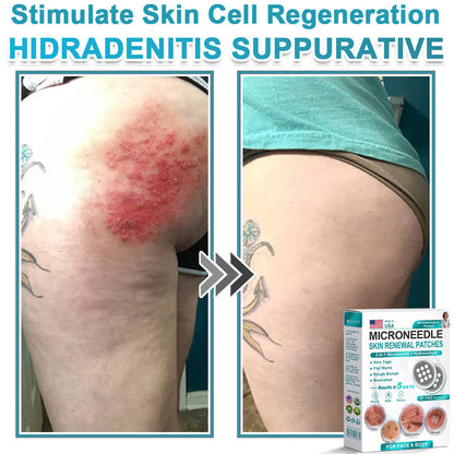 HERB & VITAL Official Store -  2-in-1 Microneedle & Hydrocolloid Patch👨‍⚕️ | Removes raised moles, acne, flat warts, and skin tags | Helps improve wrinkles, scars, and blemishes | Invisible patches for face and body