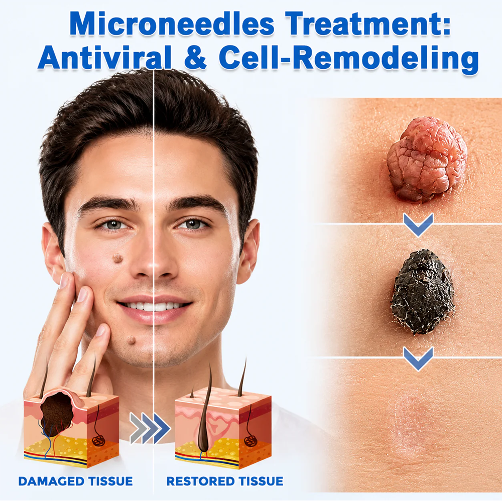 HERB & VITAL Official Store -  2-in-1 Microneedle & Hydrocolloid Patch👨‍⚕️ | Removes raised moles, acne, flat warts, and skin tags | Helps improve wrinkles, scars, and blemishes | Invisible patches for face and body