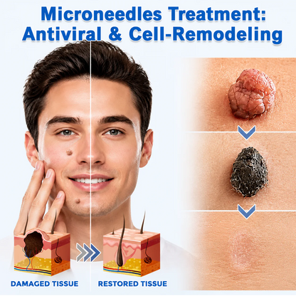 HERB & VITAL Official Store -  2-in-1 Microneedle & Hydrocolloid Patch👨‍⚕️ | Removes raised moles, acne, flat warts, and skin tags | Helps improve wrinkles, scars, and blemishes | Invisible patches for face and body