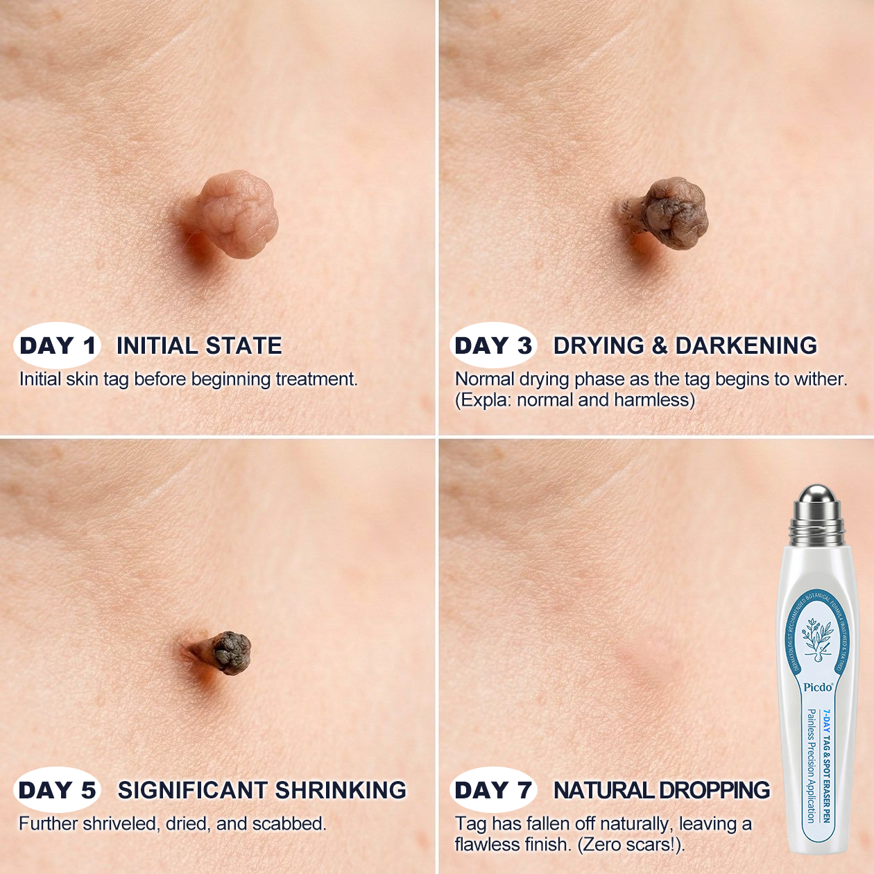 HERB & VITAL Official Store - 7 𝐷𝑎𝑦 𝗧𝐚𝐠 & 𝗦𝗽𝐨𝐭 𝐄𝐫𝒂𝒔𝒆𝒓(Zero Pain, Zero 𝐒𝐜𝐚𝒓𝒔 Rollerball)💎