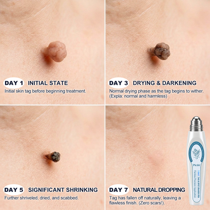 HERB & VITAL Official Store - 7 𝐷𝑎𝑦 𝗧𝐚𝐠 & 𝗦𝗽𝐨𝐭 𝐄𝐫𝒂𝒔𝒆𝒓(Zero Pain, Zero 𝐒𝐜𝐚𝒓𝒔 Rollerball)💎